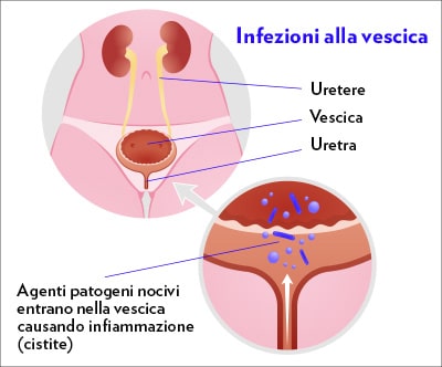 Illustrazione delle infezioni della vescica