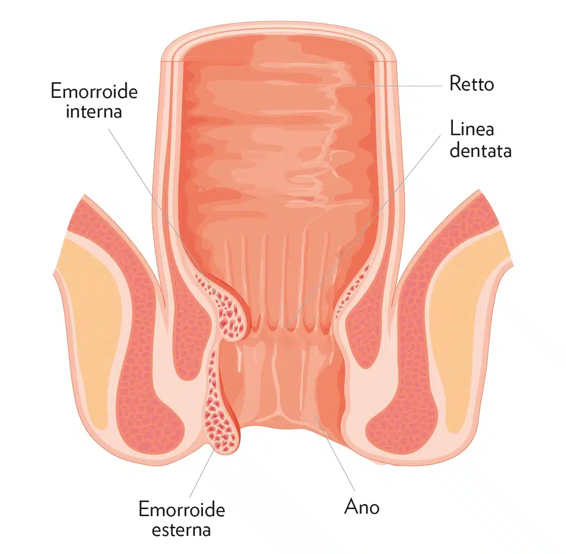 Grafica che illustra le emorroidi interne ed esterne