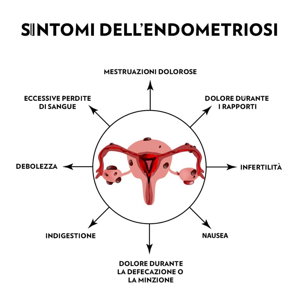 Grafica con i sintomi dell'endometriosi