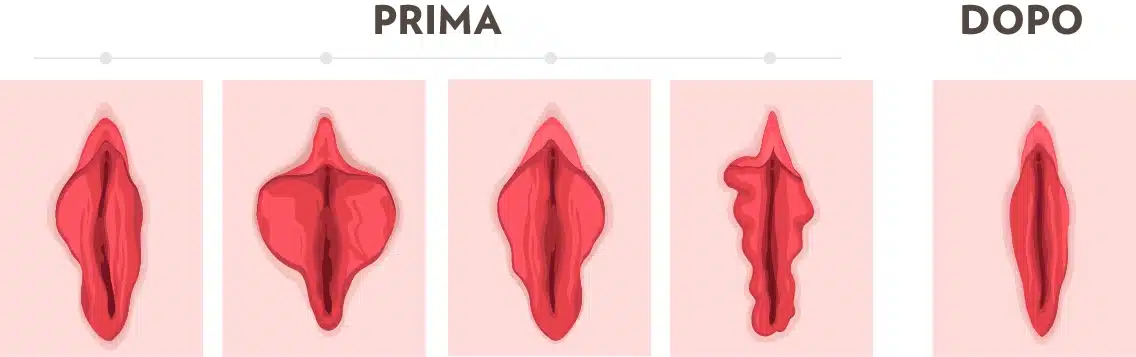 Grafica che fa vedere la vagina prima e dopo l'intervento