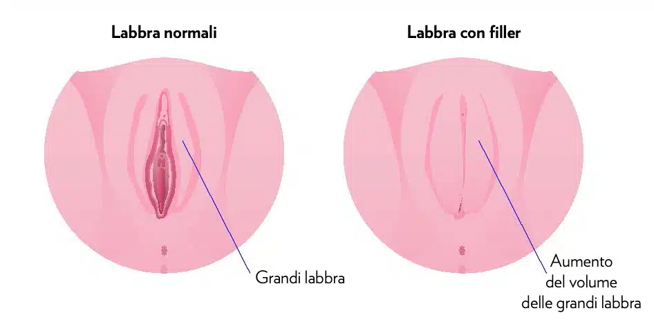 Grafico che mostra il risultato del filler vaginale