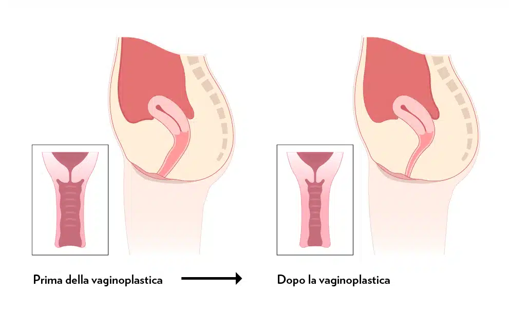 Illustrazione che mostra i risultati della vaginoplastica