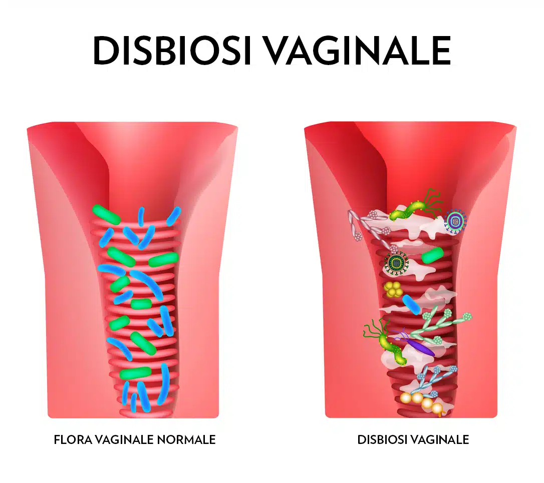 Confronto tra flora vaginale in condizioni normali e con la disbiosi